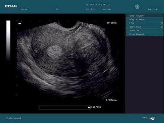 Edan_DUS_60_OB_GYN_Ultrasound_Fibroid_Uterus