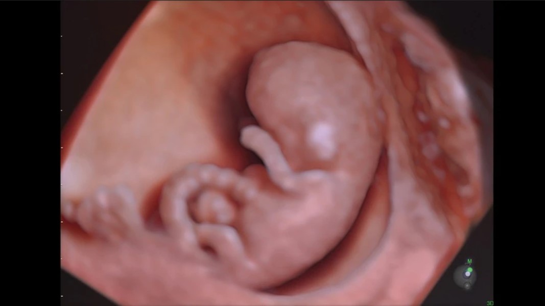 10-week fetus rendered with HDlive™ Studio