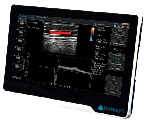 Terason_uSmart_3200T_left_view_tuss