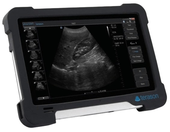 Terason_uSmart_3200T_right_view_tuss