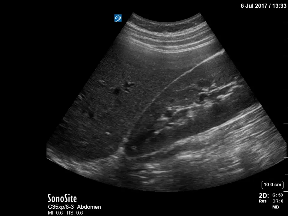 Sonosite_X-Porte_Ultrasound_with_C35xp_transducer_probe_Abdominal_Right_Upper_Quadrant_RUQ