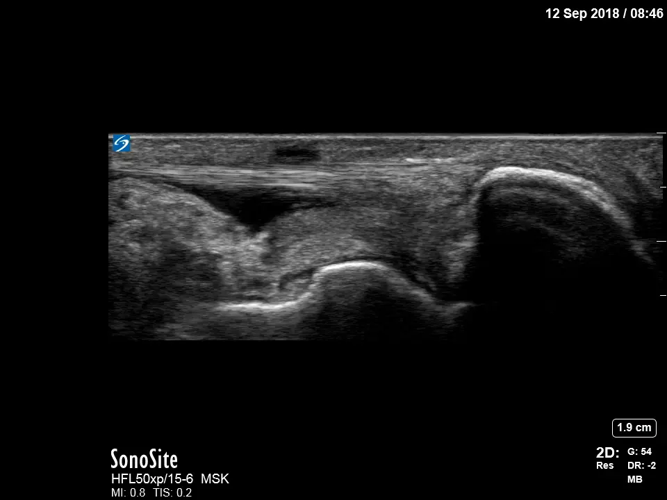 Sonosite_x-porte_xporte_ultrasound_HFL50xp_Posterior_Knee_Bakers_Cyst_HFL50_MSK_Ankle_Fluid