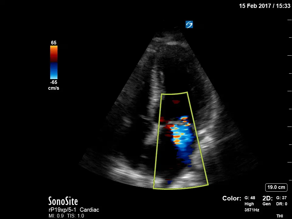 sonosite_ultrasound_with_transducer_probe_rP19xp_Cardiac_Apical_4_Chamber_with_Color_Video
