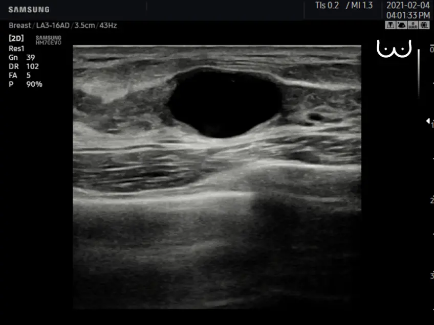 Breast cyst in 2D