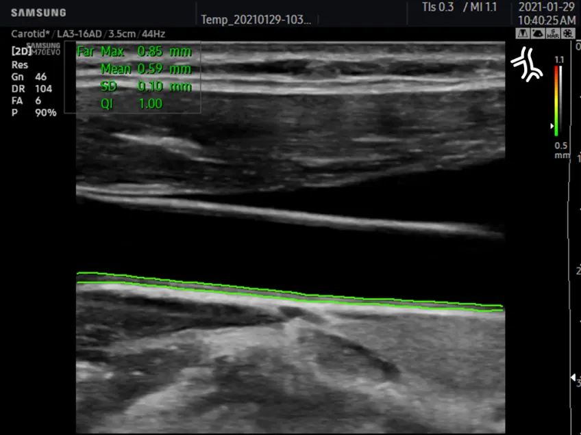 IMT measurement with AutoIMT+¹