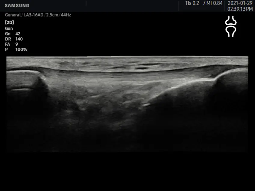 Patellar tendon in Panoramic+¹ View